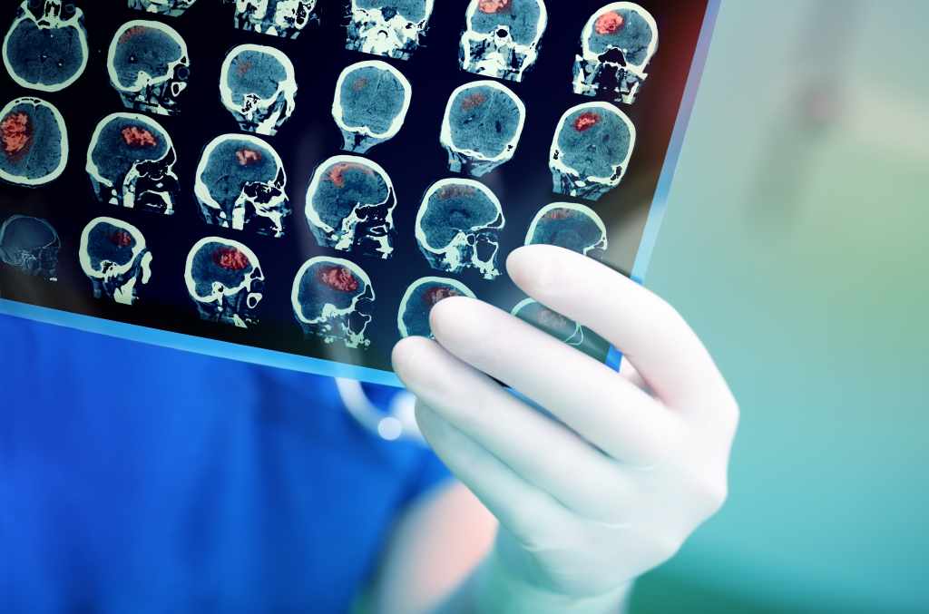 7 Gejala Tumor Otak yang Harus Anda Waspadai (Mudah Dikenali)
