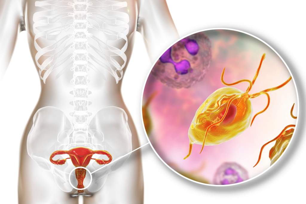 Trikomoniasis: Gejala, Penyebab, Diagnosis, dan Pengobatan