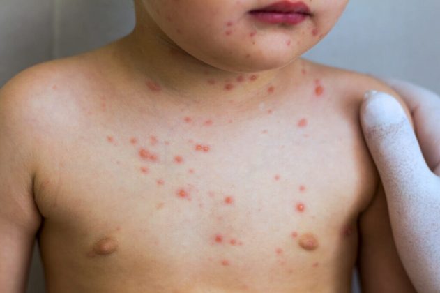 Mengenali Gejala Rubella pada Anak