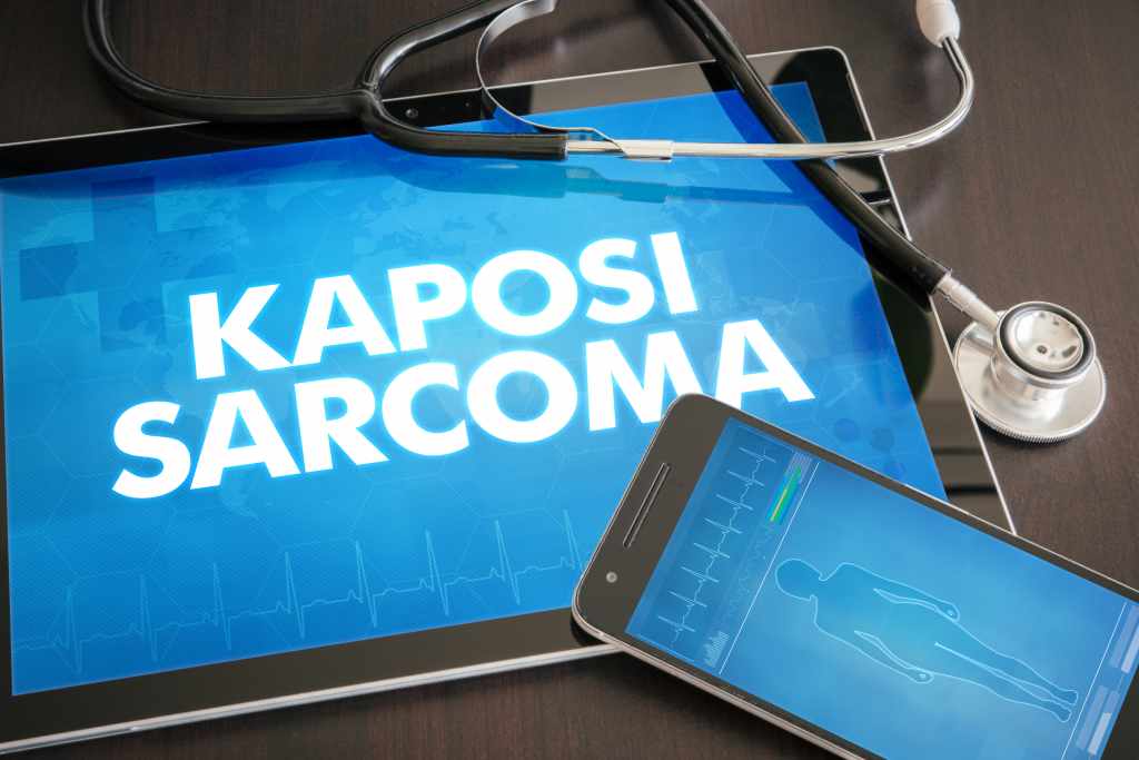 Sarkoma Kaposi: Penyebab, Gejala, Diagnosis, dan Pengobatan