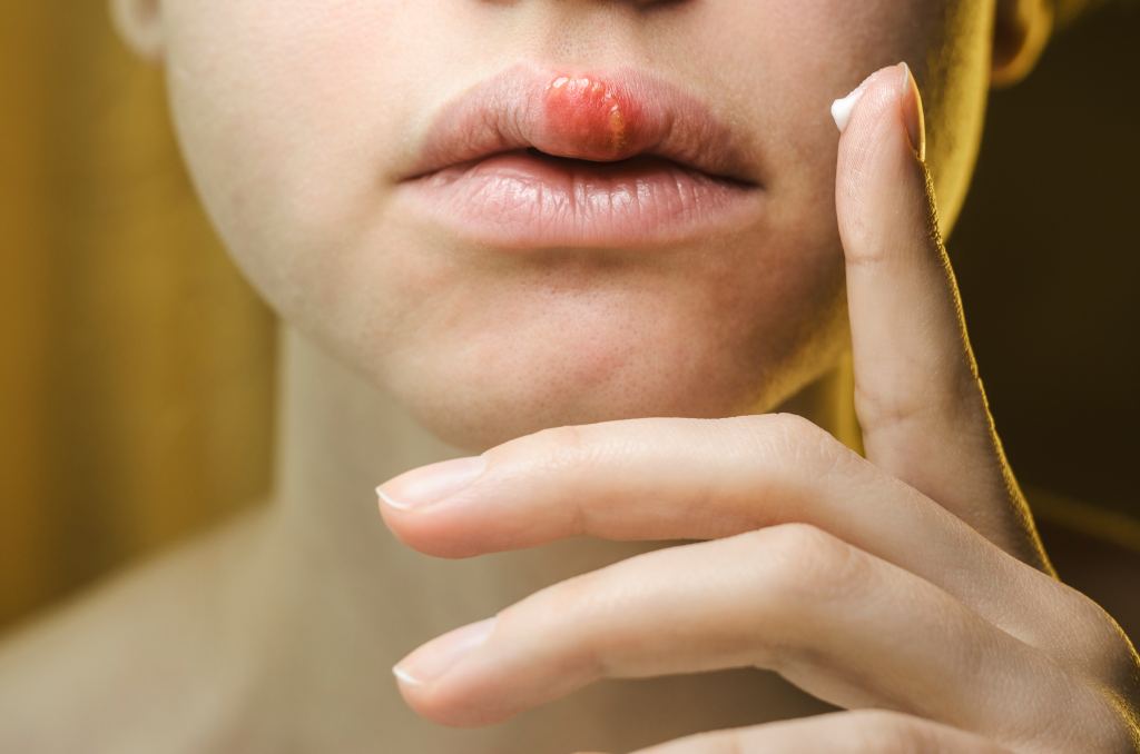 11 Cara Mengobati Luka di Bibir secara Alami, Mudah dan Cepat