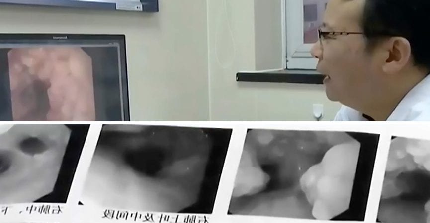 doktersehat-gigi-tumbuh-di-tenggorokan