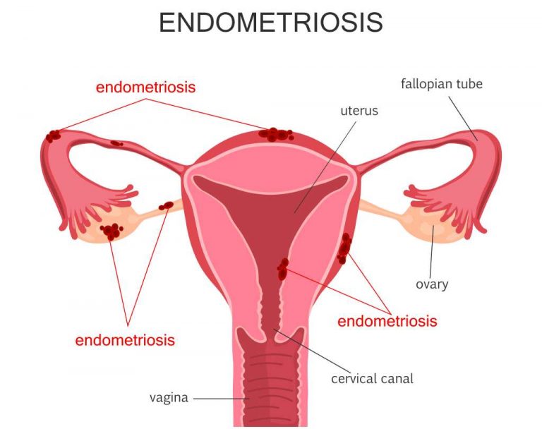 Endometriosis Gejala Penyebab Diagnosis Dan Pengobatan 