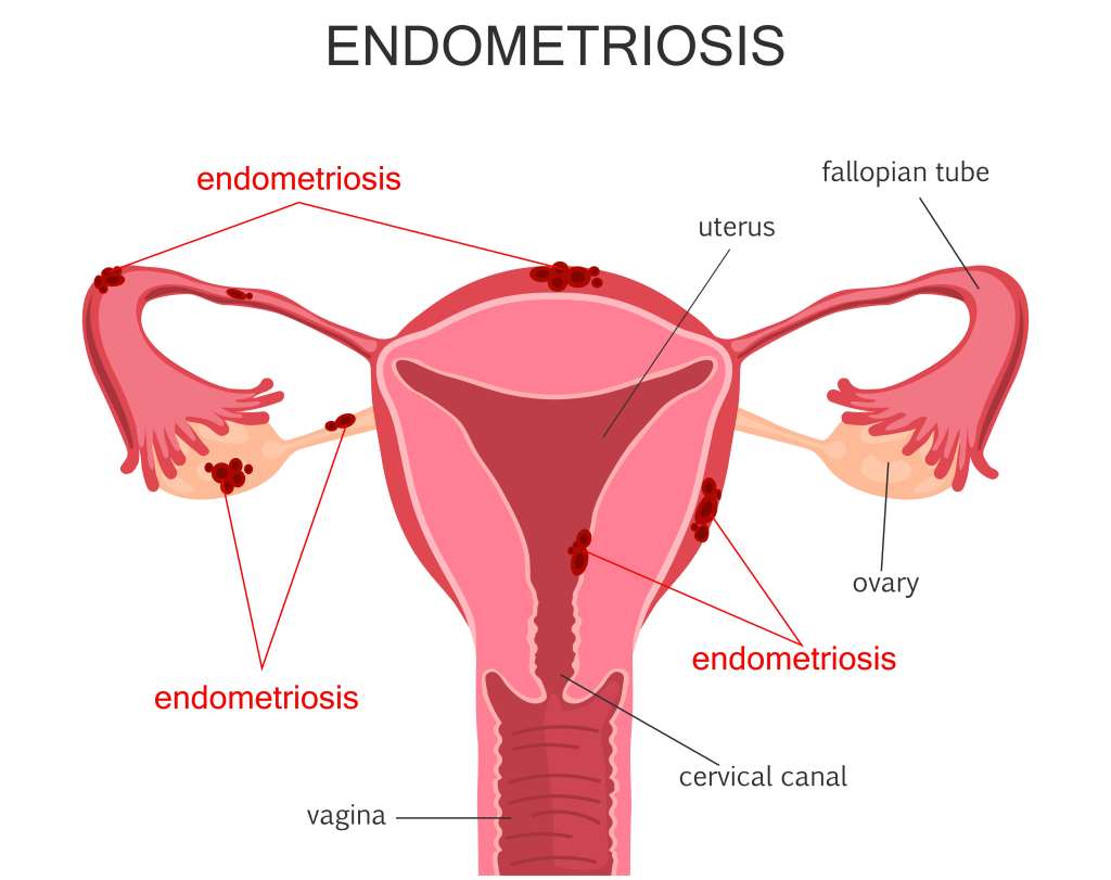 Endometriosis: Gejala, Penyebab, Diagnosis, dan Pengobatan