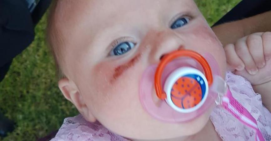 Duh, Bayi Lucu Ini Menderita Luka Bakar Setelah Pakai Tabir Surya