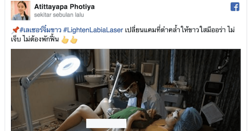 Prosedur Laser Pemutih Penis Viral di Thailand, Apa Manfaatnya?