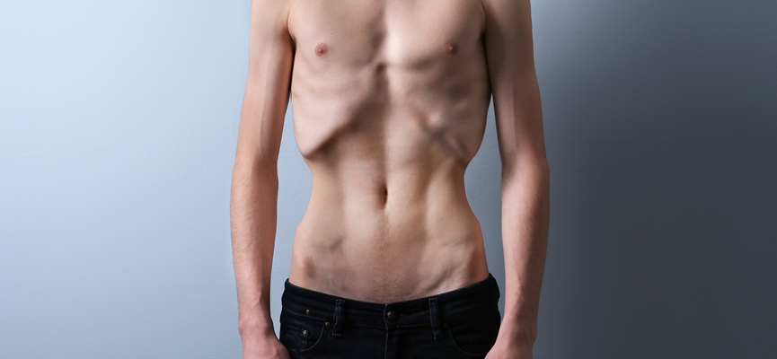 Pria Juga Bisa Mengalami Anoreksia dan Bulimia