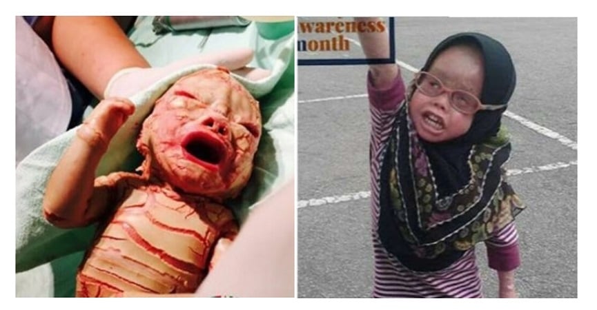 Lahir Dengan Kondisi Mengenaskan, Bayi Asal Malaysia Ini Mampu Bertahan Hidup dan Tumbuh Besar