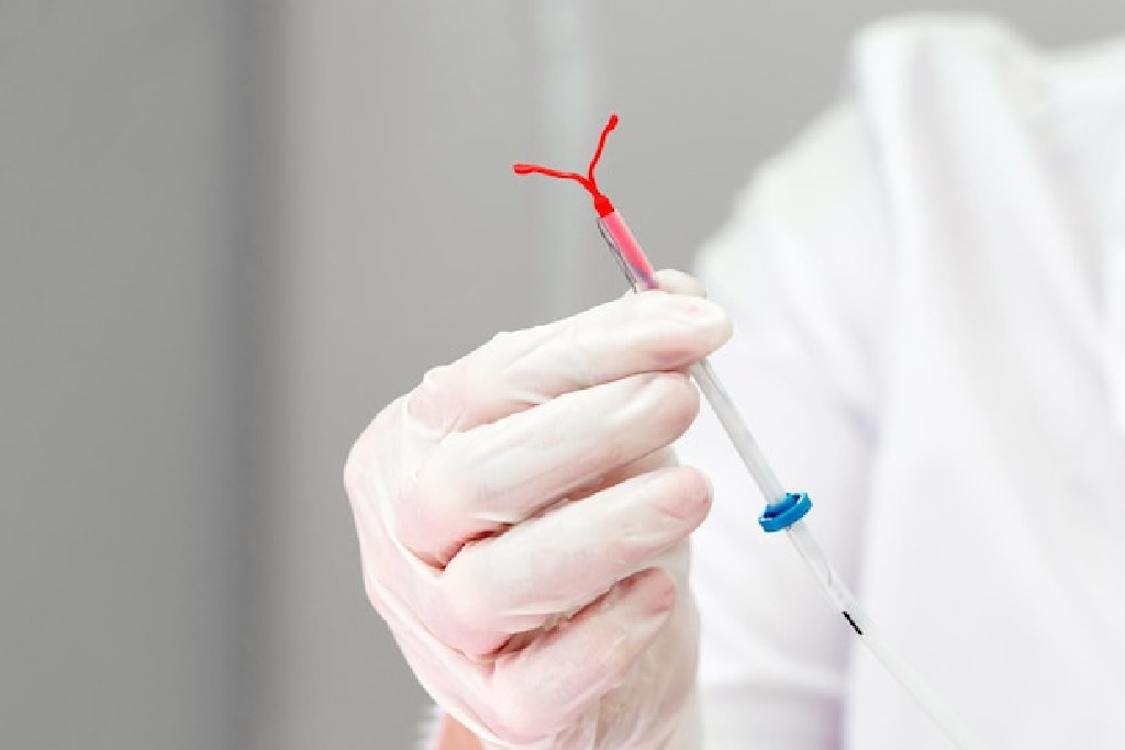 Hal yang Harus Dipertimbangan Sebelum Menggunakan IUD