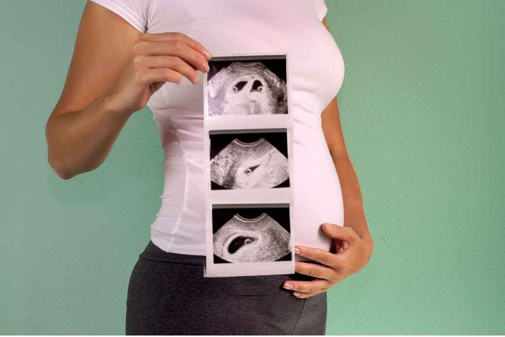 Vanishing Twin Syndrome, Ketika Bayi Kembar Hilang Dari Kandungan