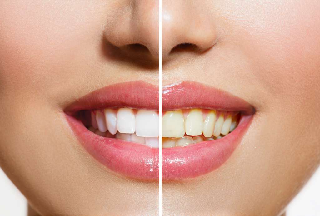 20 Cara Memutihkan Gigi Secara Alami yang Mudah dan Cepat