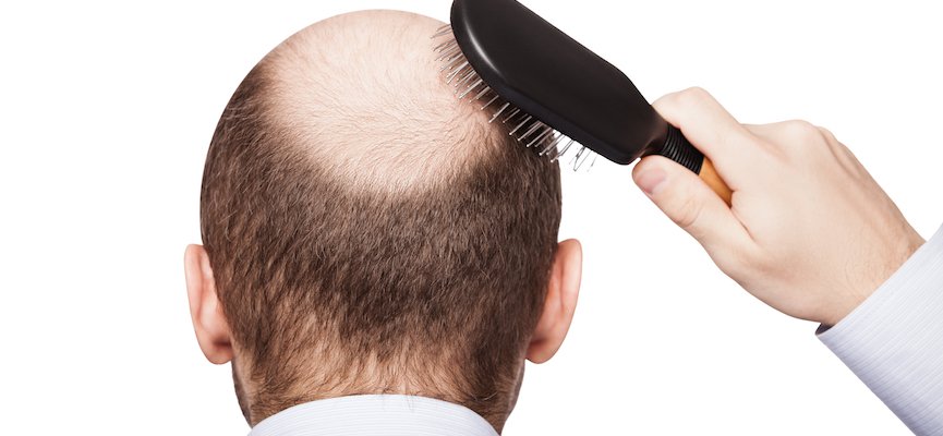 Alopecia Areata – Penanganan dan Pengobatan