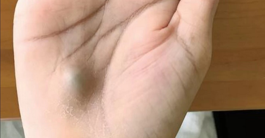 Tangan Pria Ini Benjol dan Berdenyut, Ternyata Terkena Infeksi Jantung