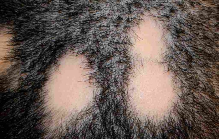 Alopecia Areata: Gejala, Penyebab, Cara Mengobati, dll - DokterSehat