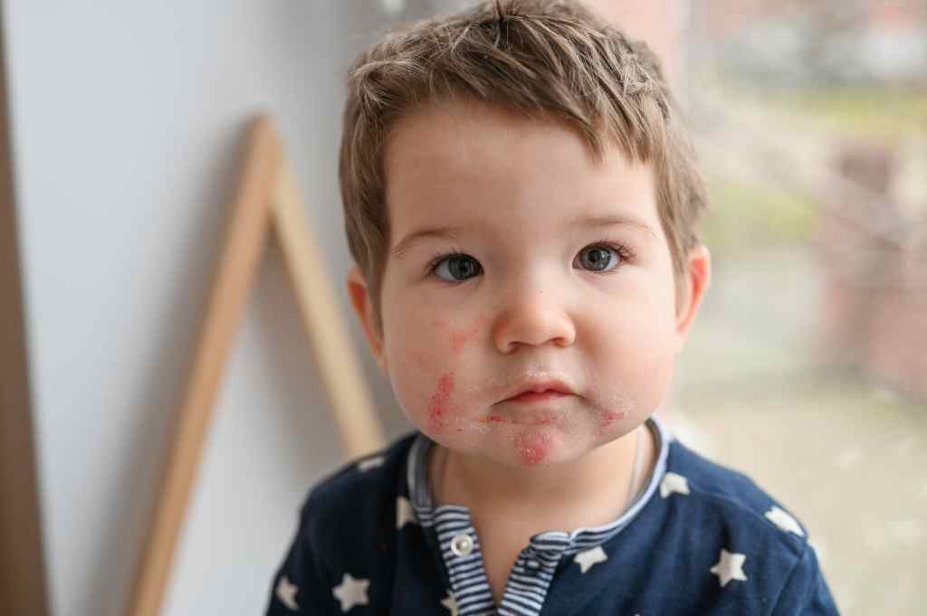 Bintik Merah pada Bayi: Penyebab dan Cara Mengatasinya