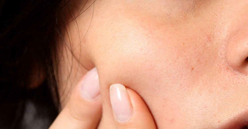 Tips Memilih Obat Jerawat yang Tepat