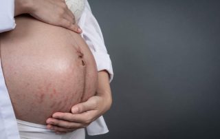 Cara Mengatasi Hiperpigmentasi pada Ibu Hamil