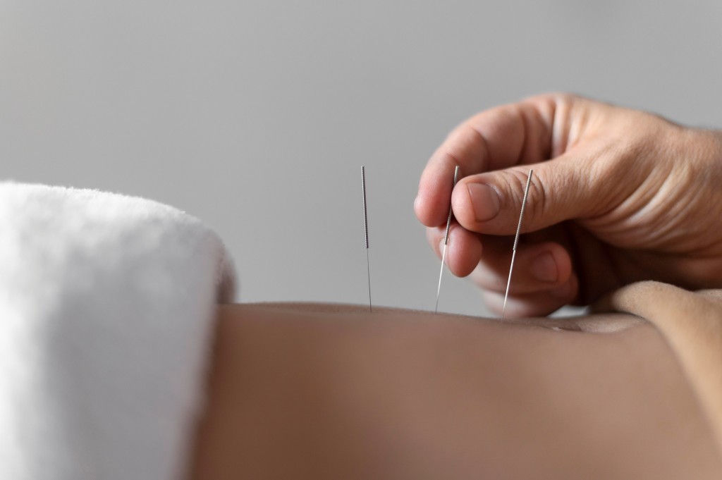 5 Titik Akupunktur untuk Tingkatkan Gairah Seks dan Redakan Stres