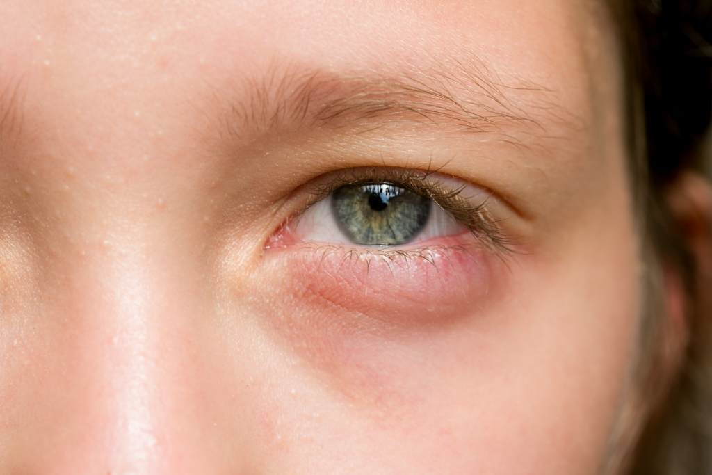 8 Penyebab Mata Bengkak pada Anak dan Cara Mengatasinya