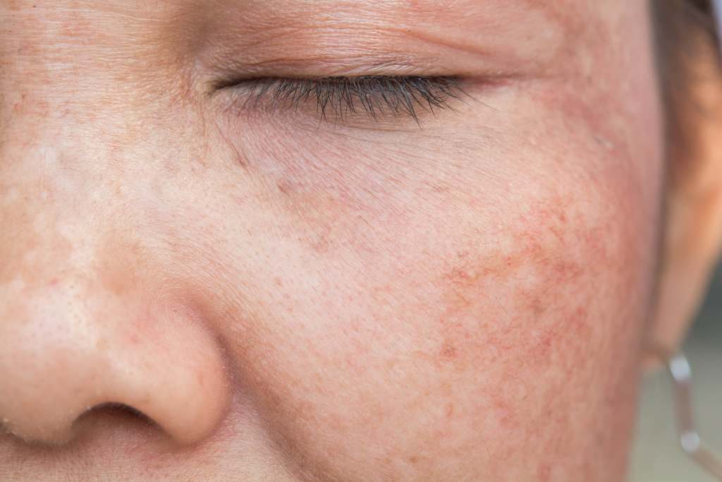 Cara Menghilangkan Vitiligo Di Wajah