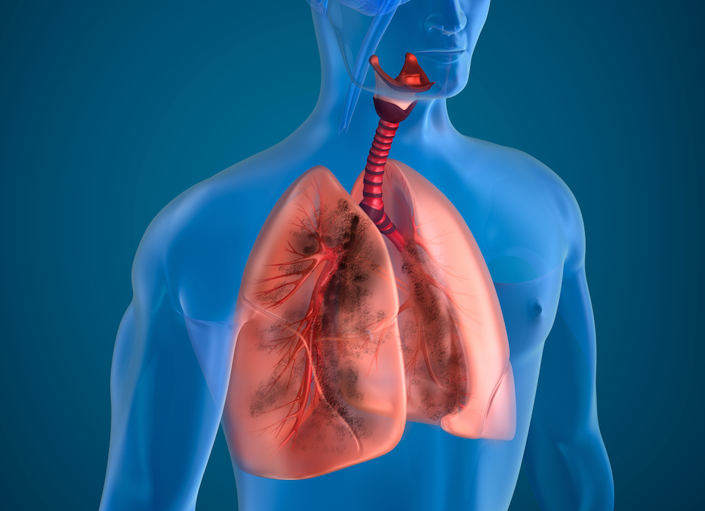 Berbagai Penyebab Pneumonia Aspirasi