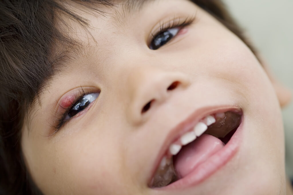 Waspada Penyebab Gigi Keropos pada Anak