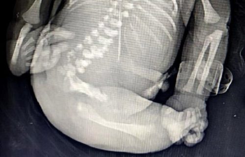 Ibu Ini Melahirkan Bayi ‘Putri Duyung’