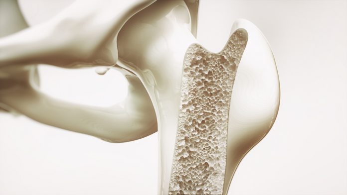 doktersehat-osteoporosis