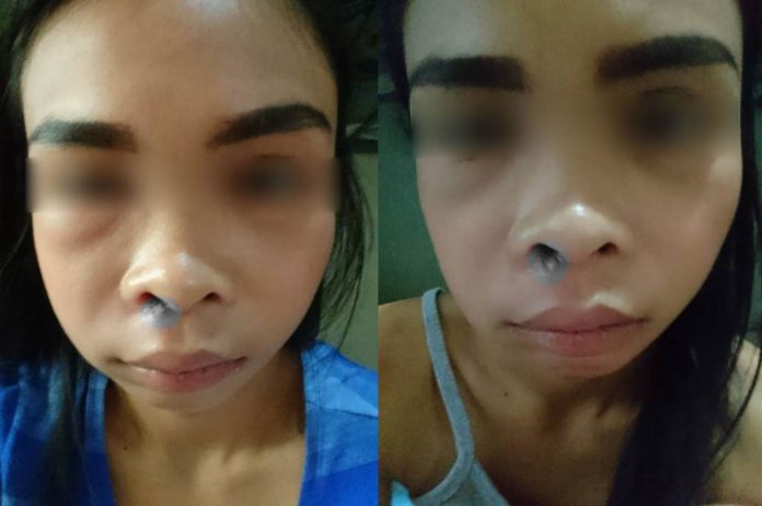 infeksi_jerawat_doktersehat_1