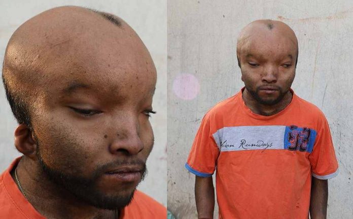 kumar_sindrom_jacobsen_doktersehat_1 kumar_sindrom_jacobsen_doktersehat_1