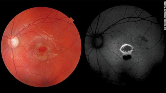 mata_terkena_laser_doktersehat_1