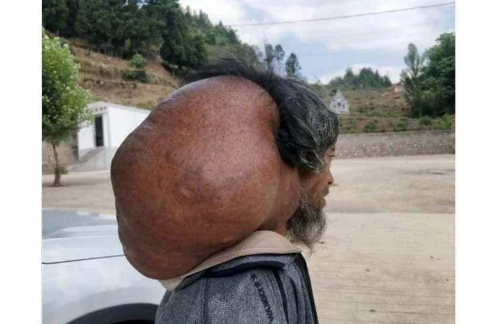 47 Tahun Tumor Raksasa Bersarang di Leher Pria Ini