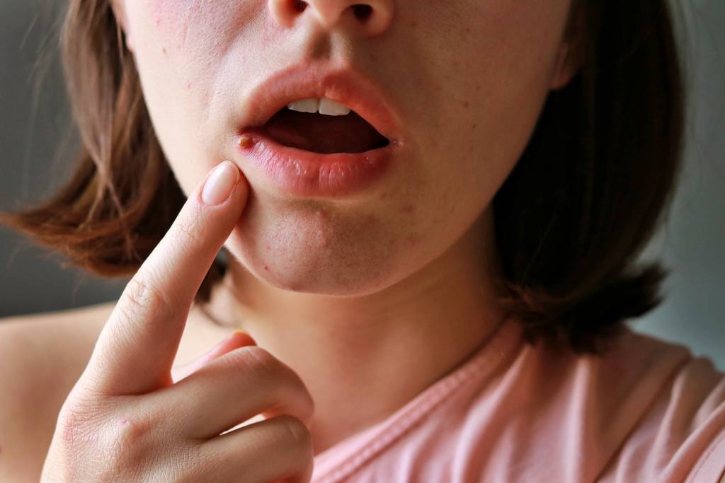 Jerawat di Bibir: Penyebab, Cara Menghilangkan, dan Pencegahan