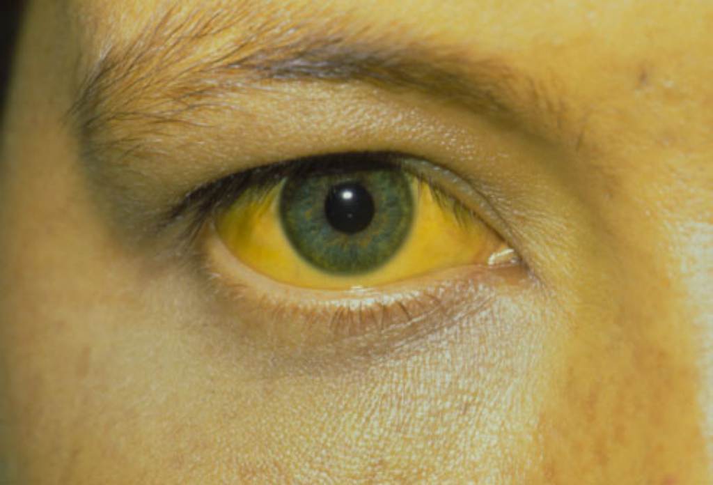 18 Obat Penyakit Kuning yang Ampuh (Alami dan Medis)