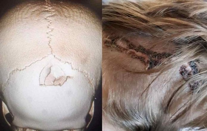 retak_tengkorak_sepeda_doktersehat_1 retak_tengkorak_sepeda_doktersehat_1