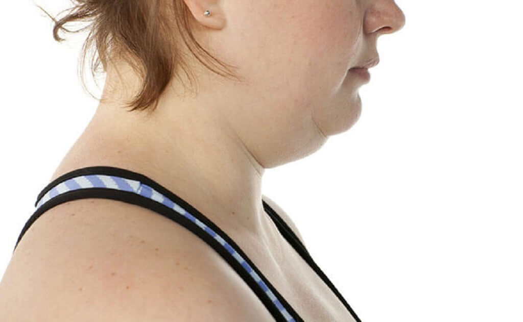 11 Cara Efektif Menghilangkan Lipatan Lemak di Leher