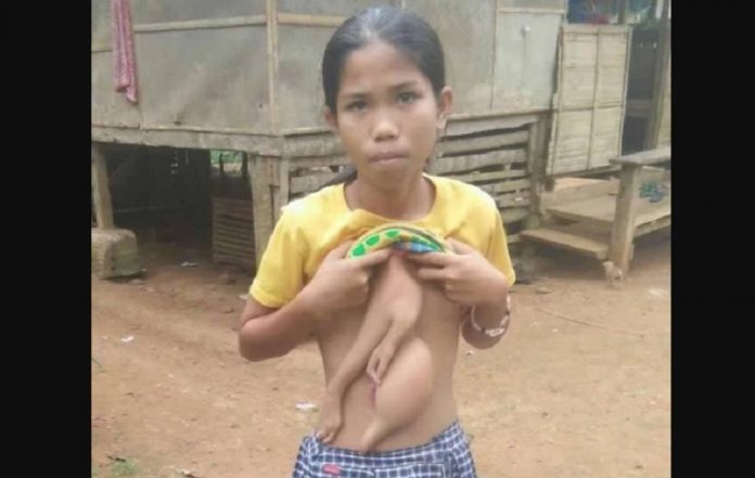 kembar_parasit_doktersehat_1