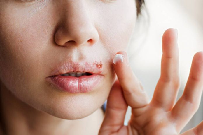 cara-mengatasi-herpes-alami-aman-doktersehat