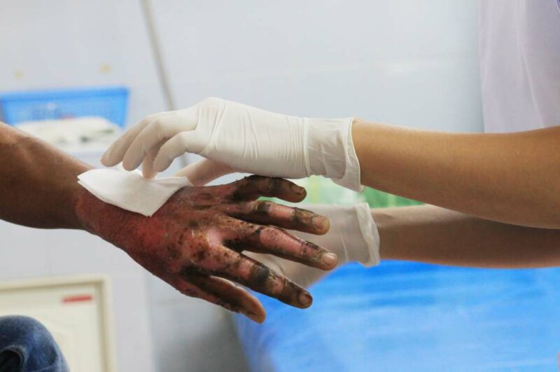 luka-bakar-doktersehat-800x531.jpg