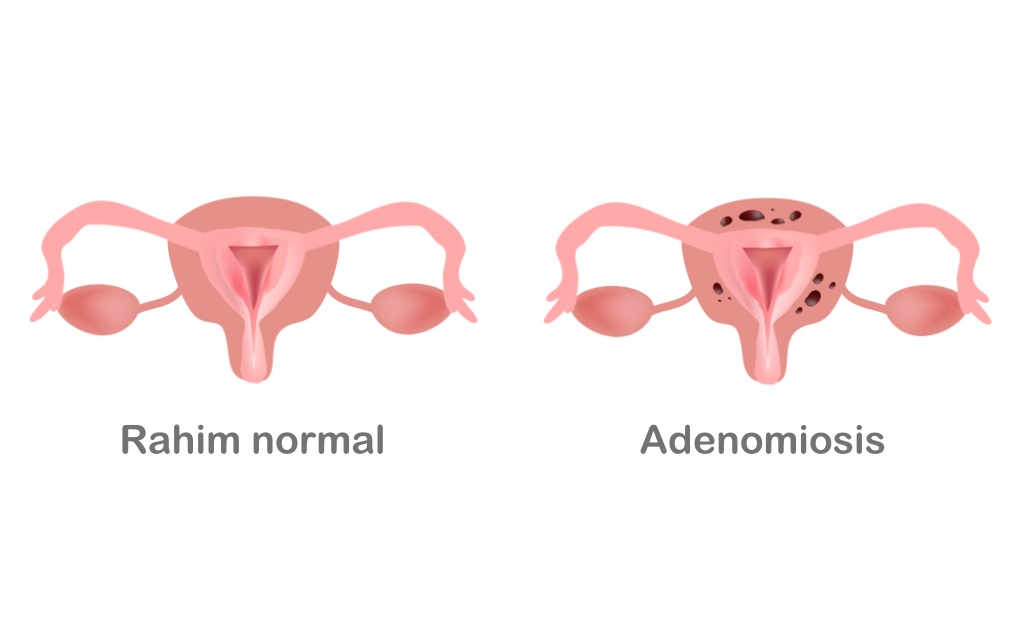 Adenomiosis y endometriosis