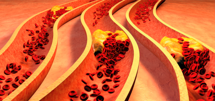 Dislipidemia: Penyebab, Gejala, Dan Lainnya