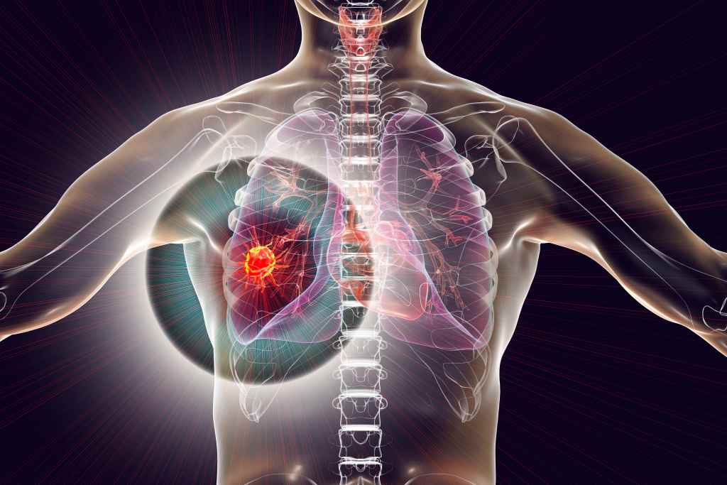 Kanker Paru-paru: Penyebab, Gejala, dan Pengobatan