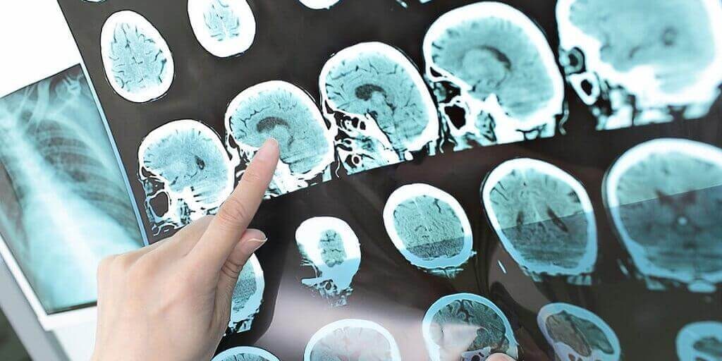 Aneh, Tumor Otak Gadis Ini Tiba-Tiba Lenyap Begitu Saja