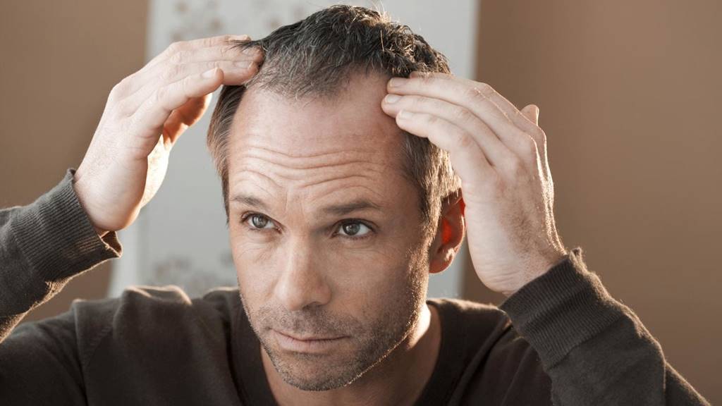 Mengenal Alopecia Barbae, Penyakit Botak pada Pria
