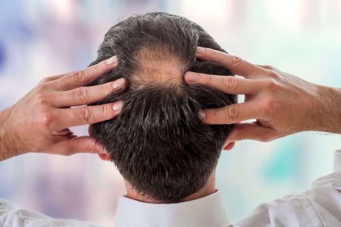 rambut-rontok-kebotakan-doktersehat