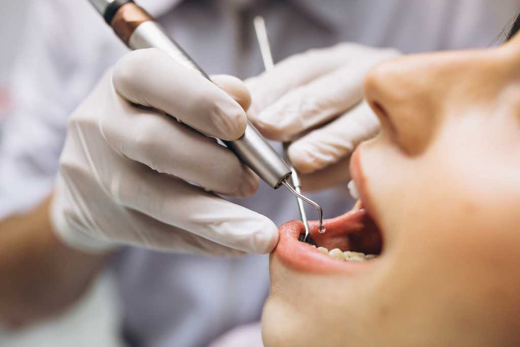 10 Cara Menghilangkan Karang Gigi yang Efektif