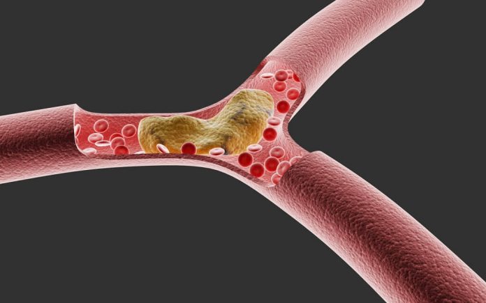 aterosklerosis-adalah-doktersehat