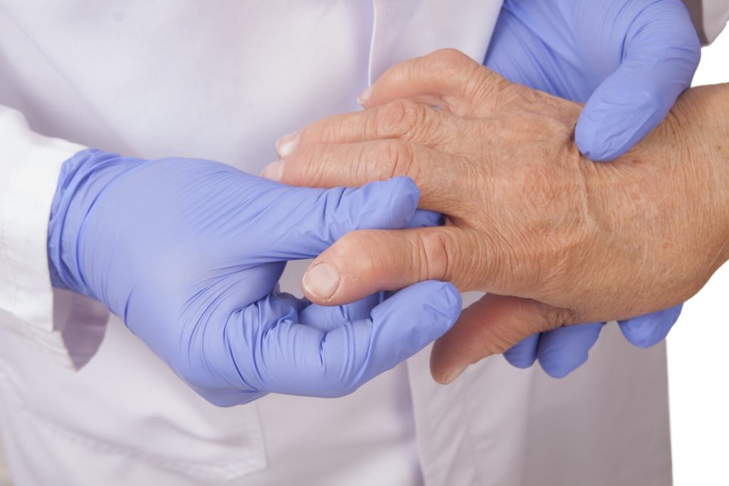 Rheumatoid Arthritis: Gejala, Penyebab, Diagnosis, dan Pengobatan
