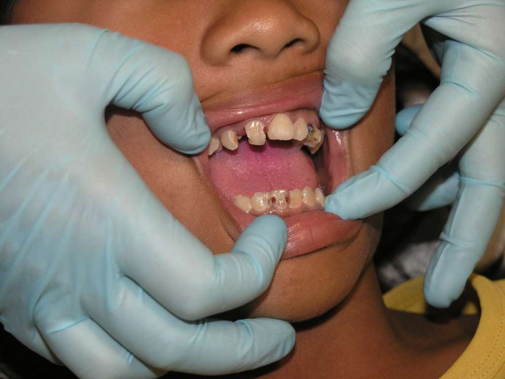 Penyebab Gigi Anak Rusak dan Cara Merawatnya