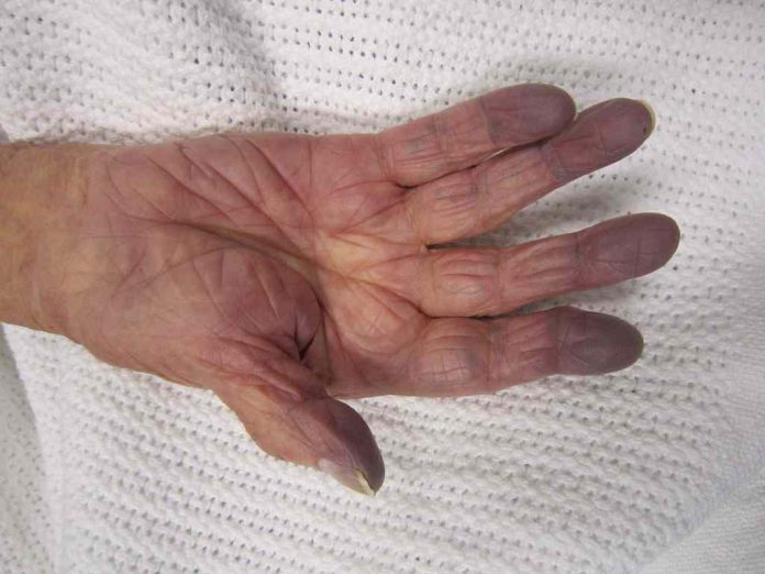 sianosis-adalah-doktersehat sianosis-doktersehat